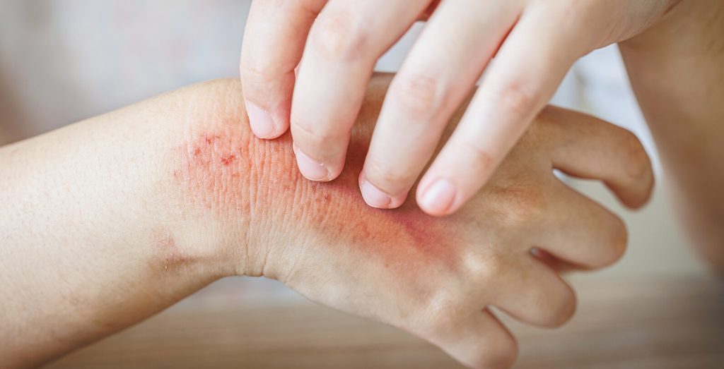 Image of hands with a red patch on them.